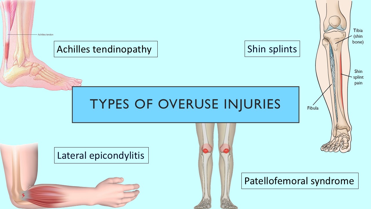 PowerPoint slide on different types of overuse injuries in sport